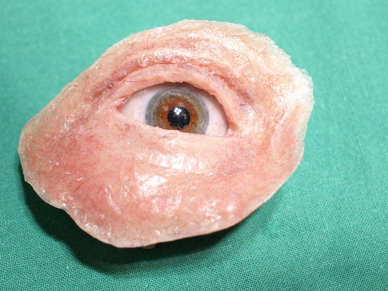 Orbitaepithese rechts nach Enukleation des Auges wegen eines infiltrierenden Spinalioms der Haut