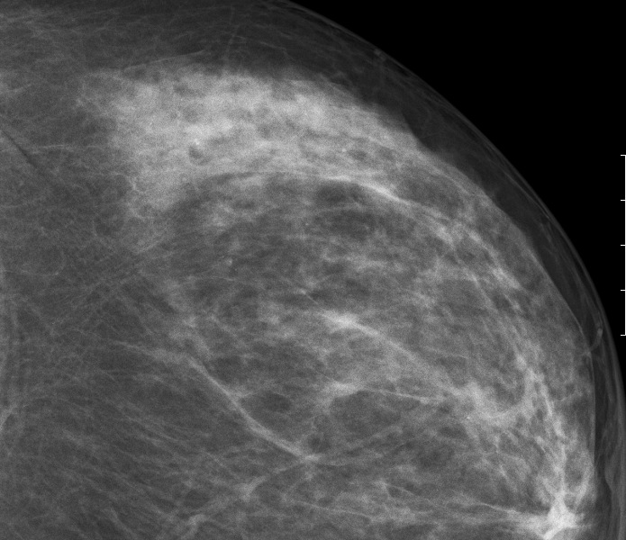 Mikrokalk in Mammographie