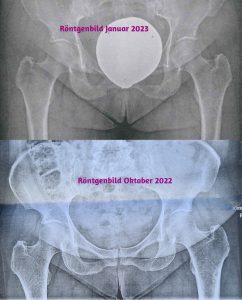 ...laufen ging nicht mehr: Röntgen zweimal in gleicher Position schwer zu sehen 
