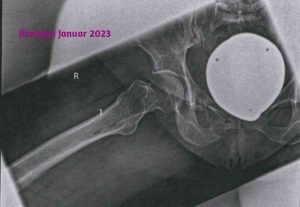  ...laufen ging nicht mehr: Röntgenbild mit leichter erkennbarem Bruch
